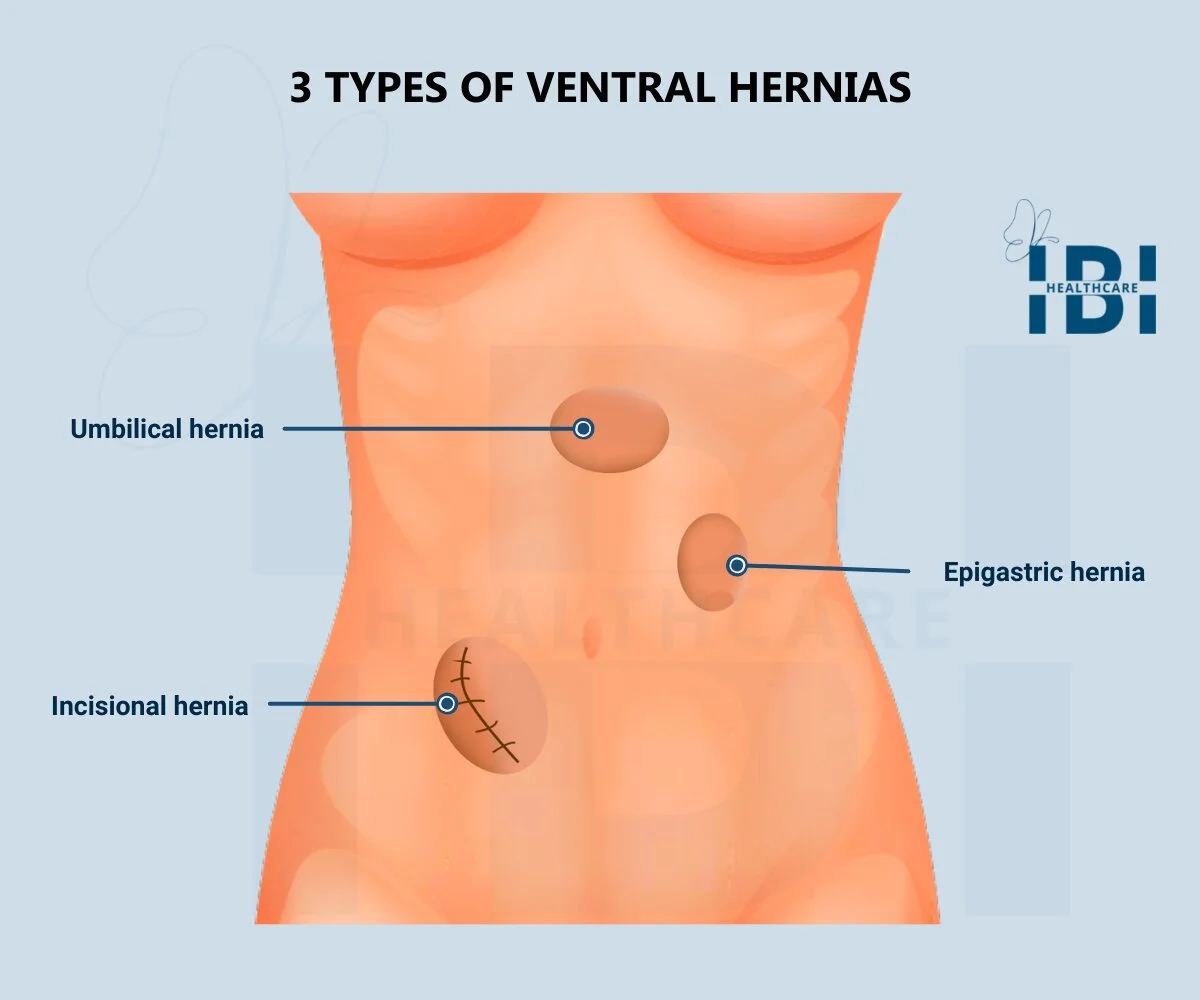 Hernia ventral (pared)
