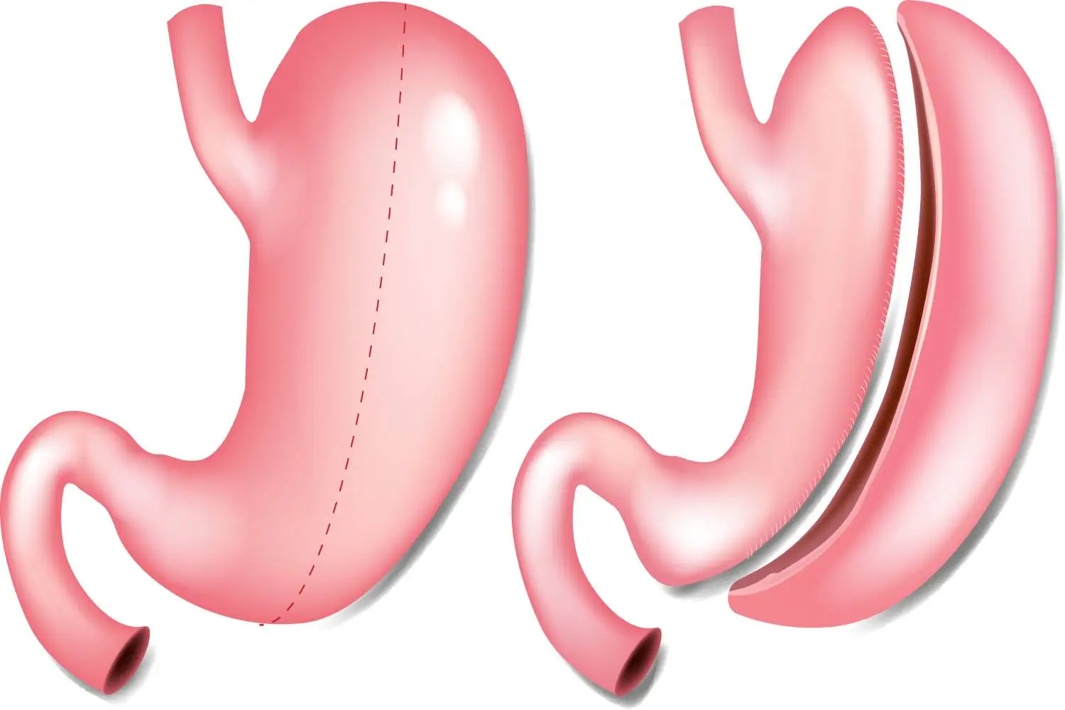 Consulta sobre cirugía de obesidad