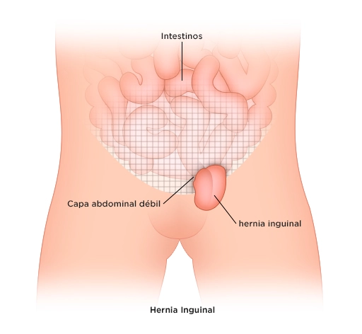 Procedimiento de hernia inguinal